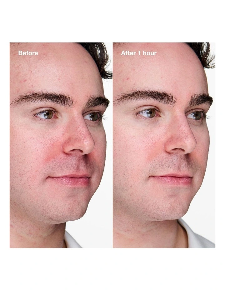 Clear Skin Routine: Mini Anti-Blemish Solutions Kit image 4