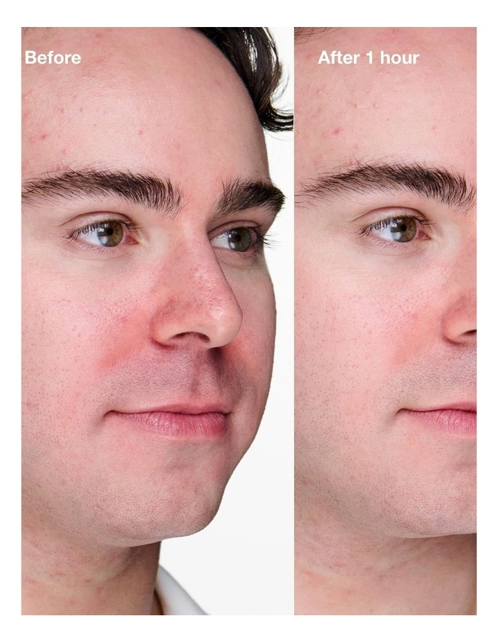 Anti-Blemish Solutions Clinical? Advanced Clearing Gel 10ml image 5
