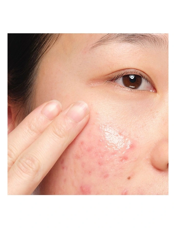 Aloe 2%   NAG 2% Solution - Soothing and Lightweight Hydration for Post-Acne Marks 30ml image 5