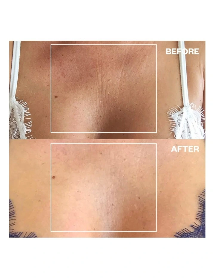 Chest Wrinkle Patch - 1 Patch image 5