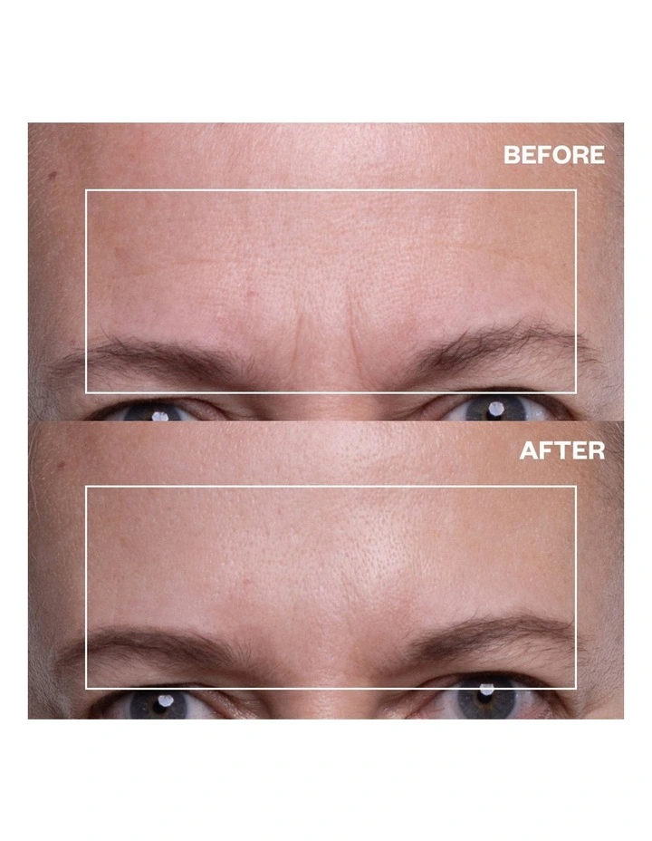 Forehead Wrinkle Patch - 2 Patches image 3