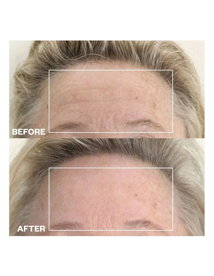 Forehead Wrinkle Patch - 2 Patches image 5