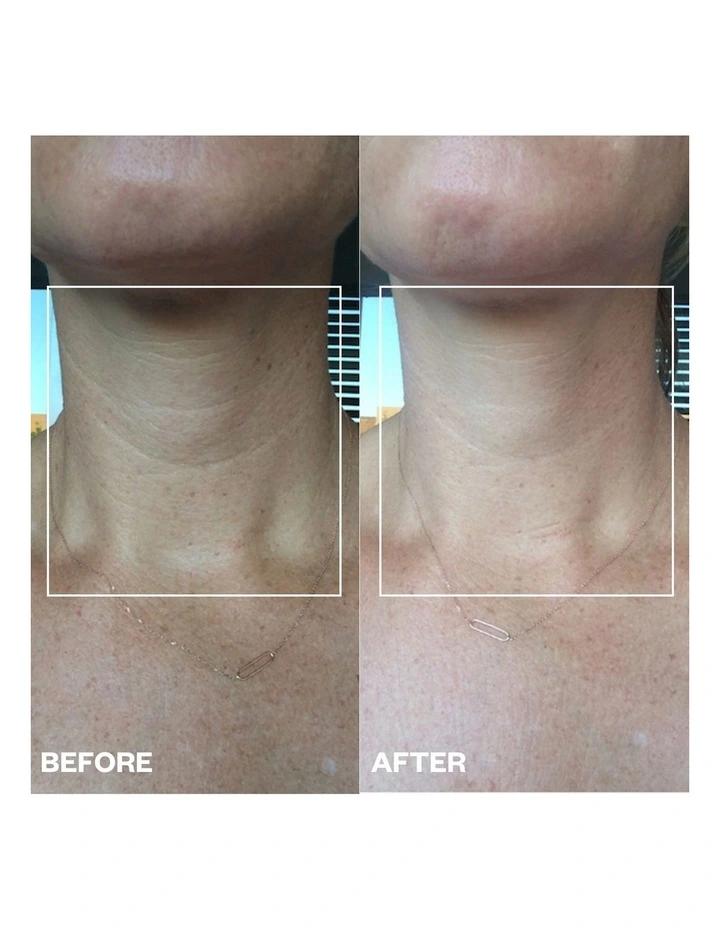 Neck Wrinkle Patch - 1 Patch image 3