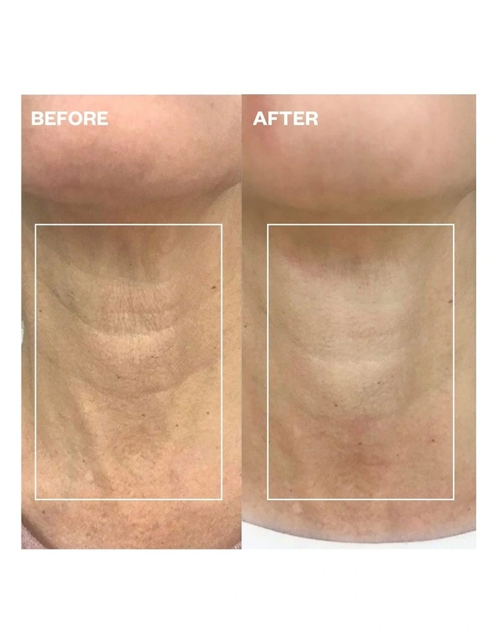 Neck Wrinkle Patch - 1 Patch image 5