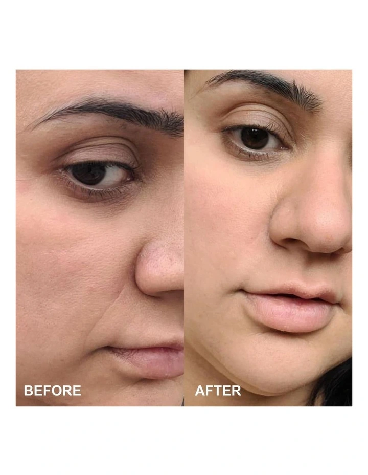 Self-Dissolving Microneedle Patches - 8 Patches image 3