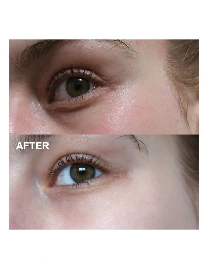 Self-Dissolving Microneedle Patches - 8 Patches image 6