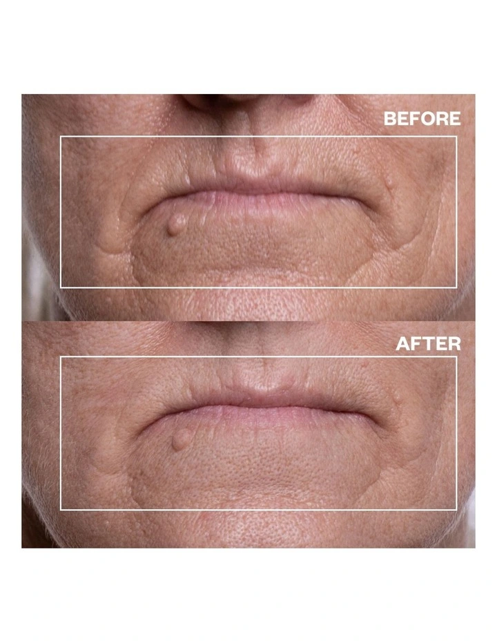 Mouth & Lip Wrinkle Patches - 2 Patches image 3