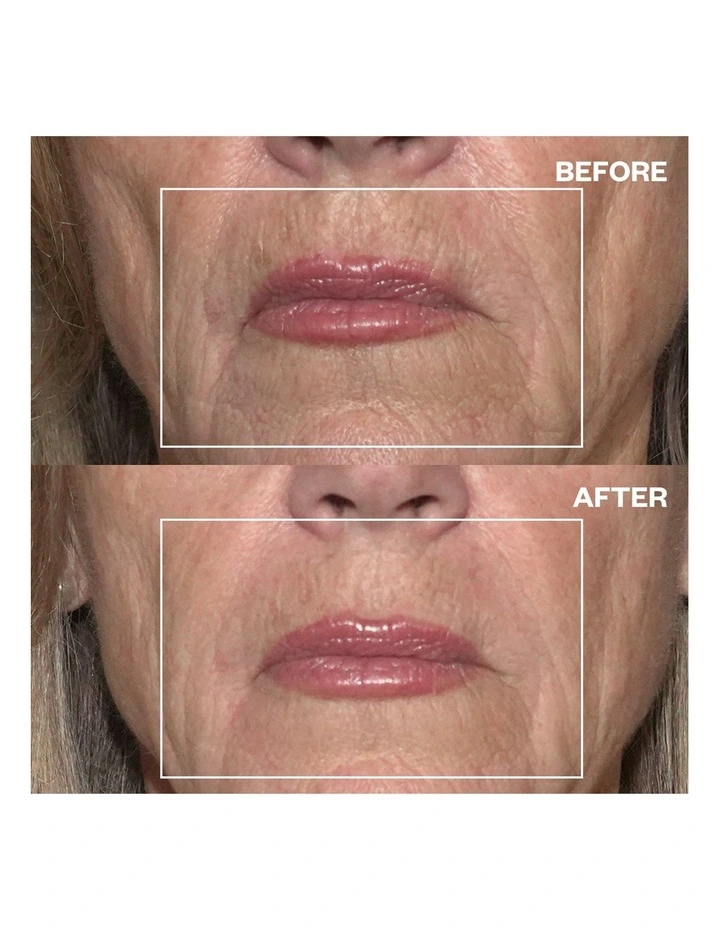 Mouth & Lip Wrinkle Patches - 2 Patches image 5