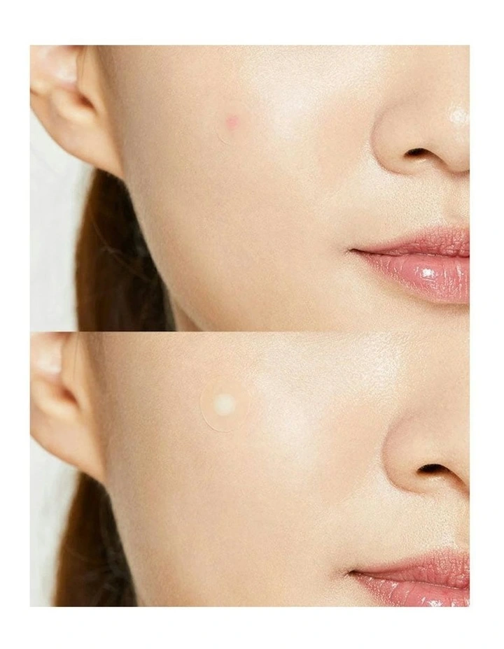 Acne Pimple Master Patch Bundle 5 Piece image 6